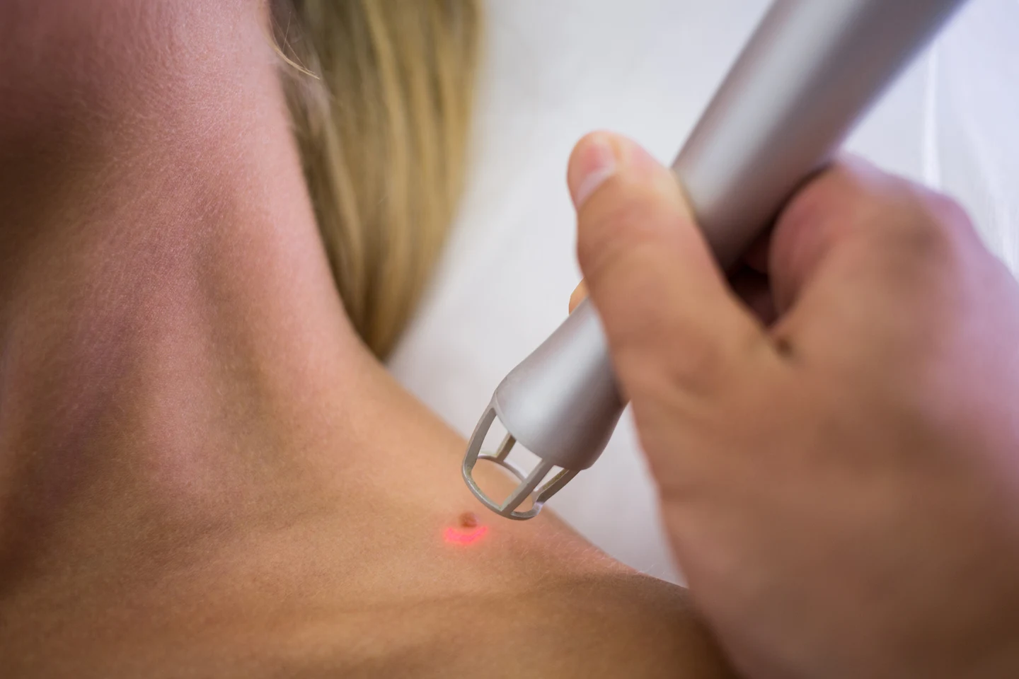 Jato de Plasma dermatologist-removing-mole-from-womans-shoulder